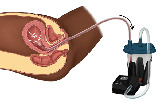 Diagram of uterine suction tamponade: a tube is placed inside the uterus and connected through tubing to the VATARA pump, which applies negative pressure to help control bleeding.